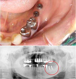 インプラント2