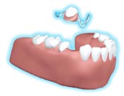 部分入れ歯